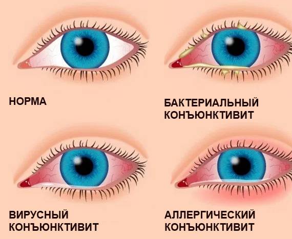 Причины и методы лечения фолликулярного конъюнктивита - мед портал tvoiamedkarta.ru