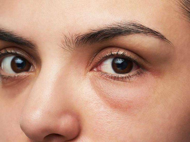 Темные круги под глазами у мужчин - причины каких болезней