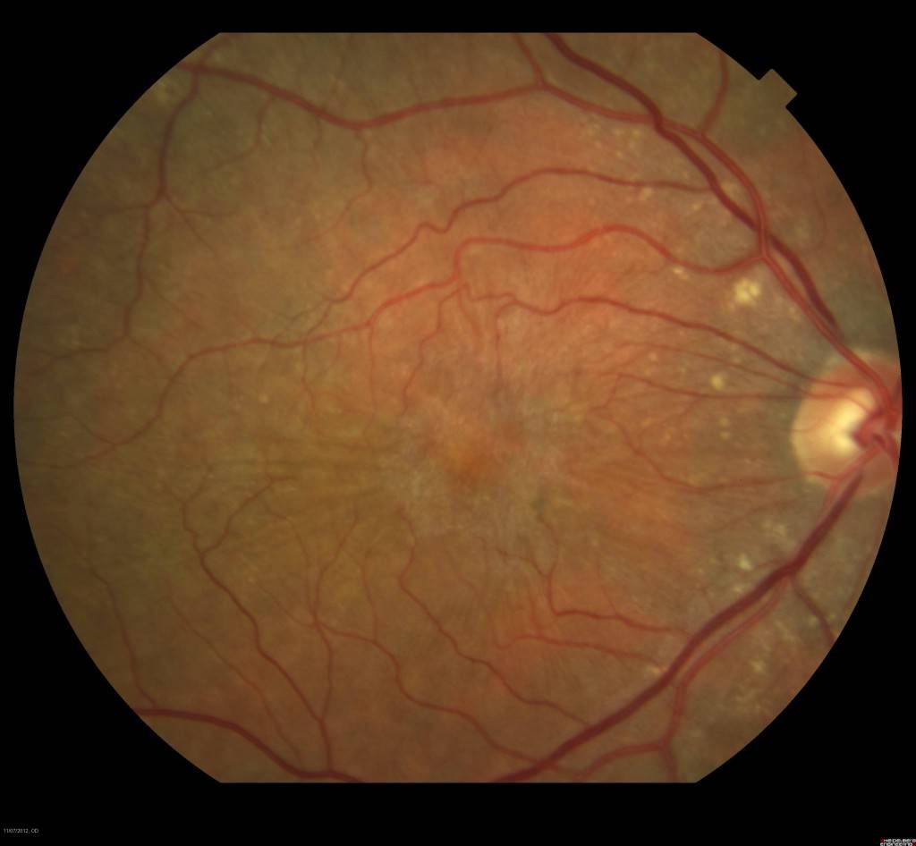 Эпиретинальный фиброз глаза - что это такое, методы лечения целлофановой мембраны в макулярной зоне сетчатки пожилого человека