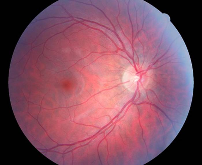 Дистрофия сетчатки глаза: патология зрения, которая приводит к серьезным последствиям