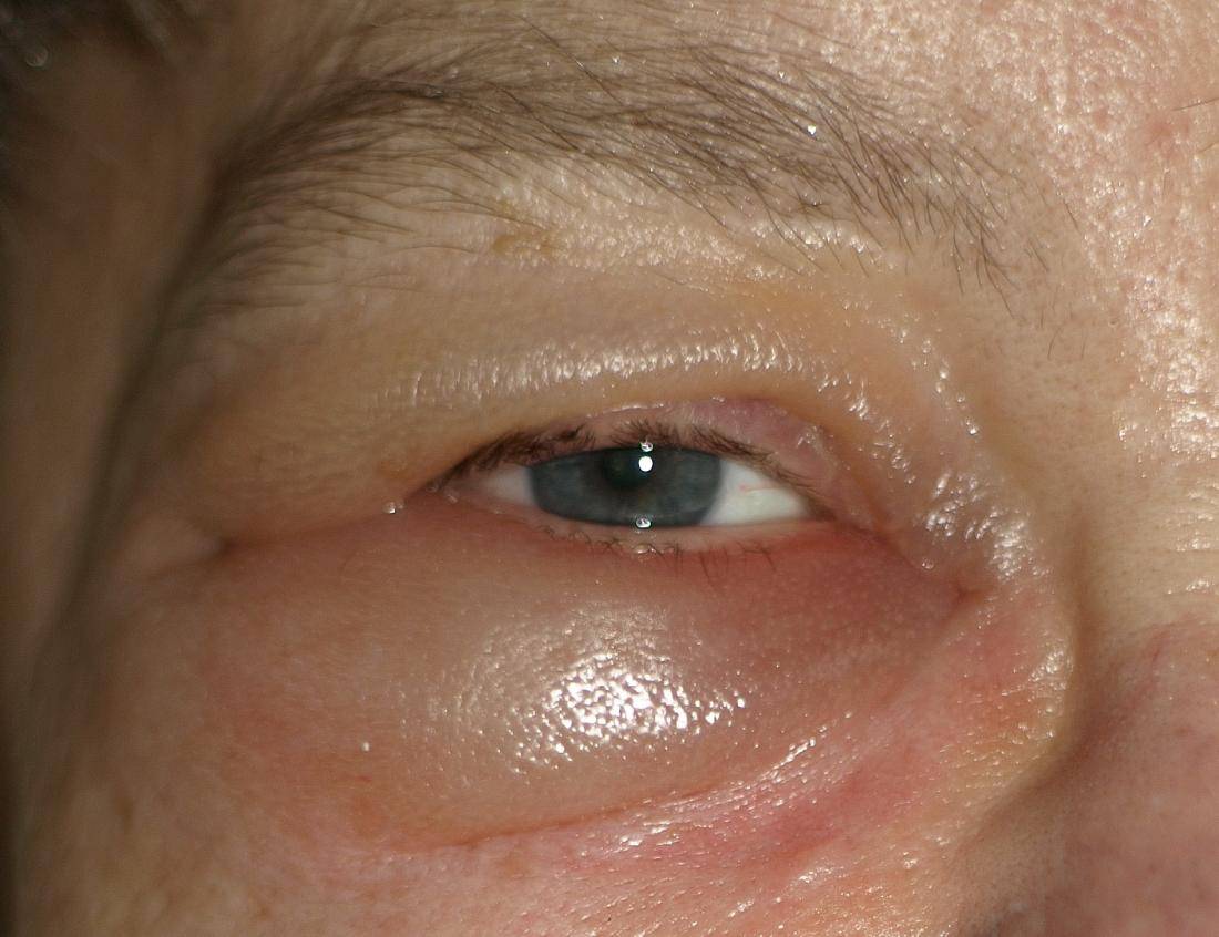 Отекают верхние веки глаз: причины, симптомы, диагностика и лечение