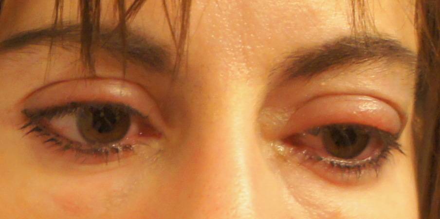 Отек глаз при аллергии: ? лечение, что делать если чешутся и опухают?