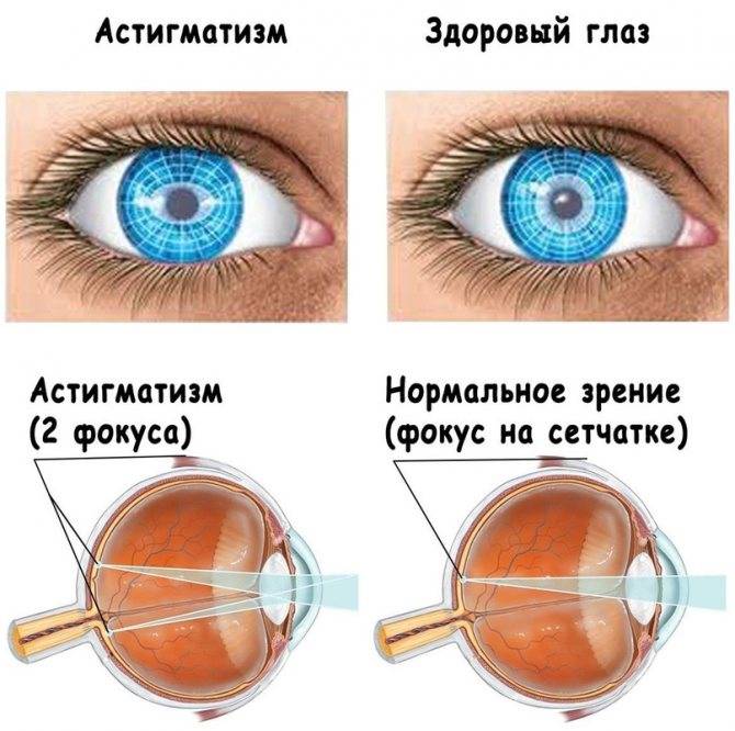 Очки при астигматизме: как подобрать и нужно ли постоянно их носить