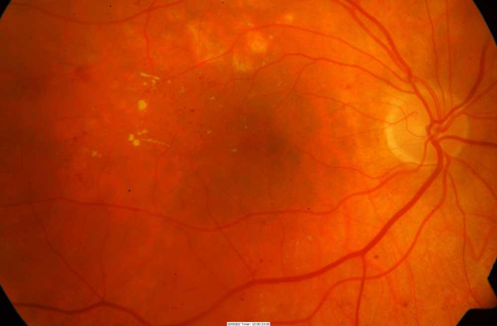 Макулярный отек сетчатки глаза - лечение, причины и симптомы