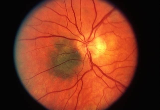 Меланома хориоидеи глаза: симптомы, причины, лечение