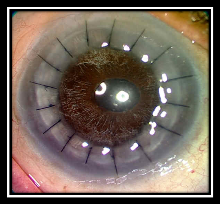 Пересадка роговицы глаза (кератопластика) - последствия, как проходит
