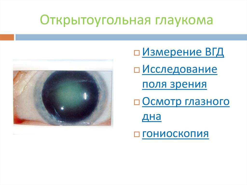 Для открытоугольной глаукомы характерны тест. Закрытоугольная глаукома гониоскопия. Глаукома поля зрения. Открытоугольная глаукома поля зрения. Симптомы открытоугольной глаукомы.