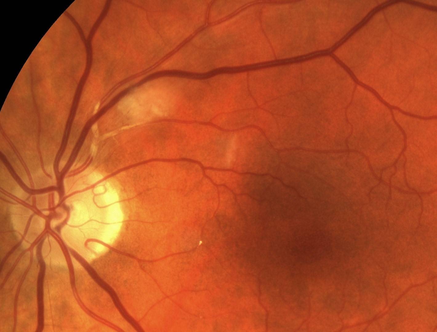 Ангиосклероз сетчатки глаза что это такое, или чем опасна для зрения гипертония