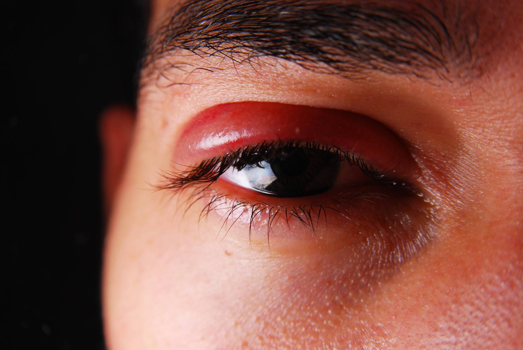Болят глаза при простуде, орви или гриппе без температуры: причины светобоязни