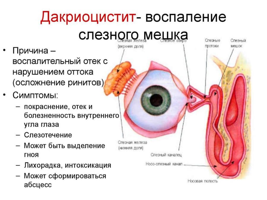 Воспаление слёзного канала у взрослых: симптомы и лечение oculistic.ru
воспаление слёзного канала у взрослых: симптомы и лечение