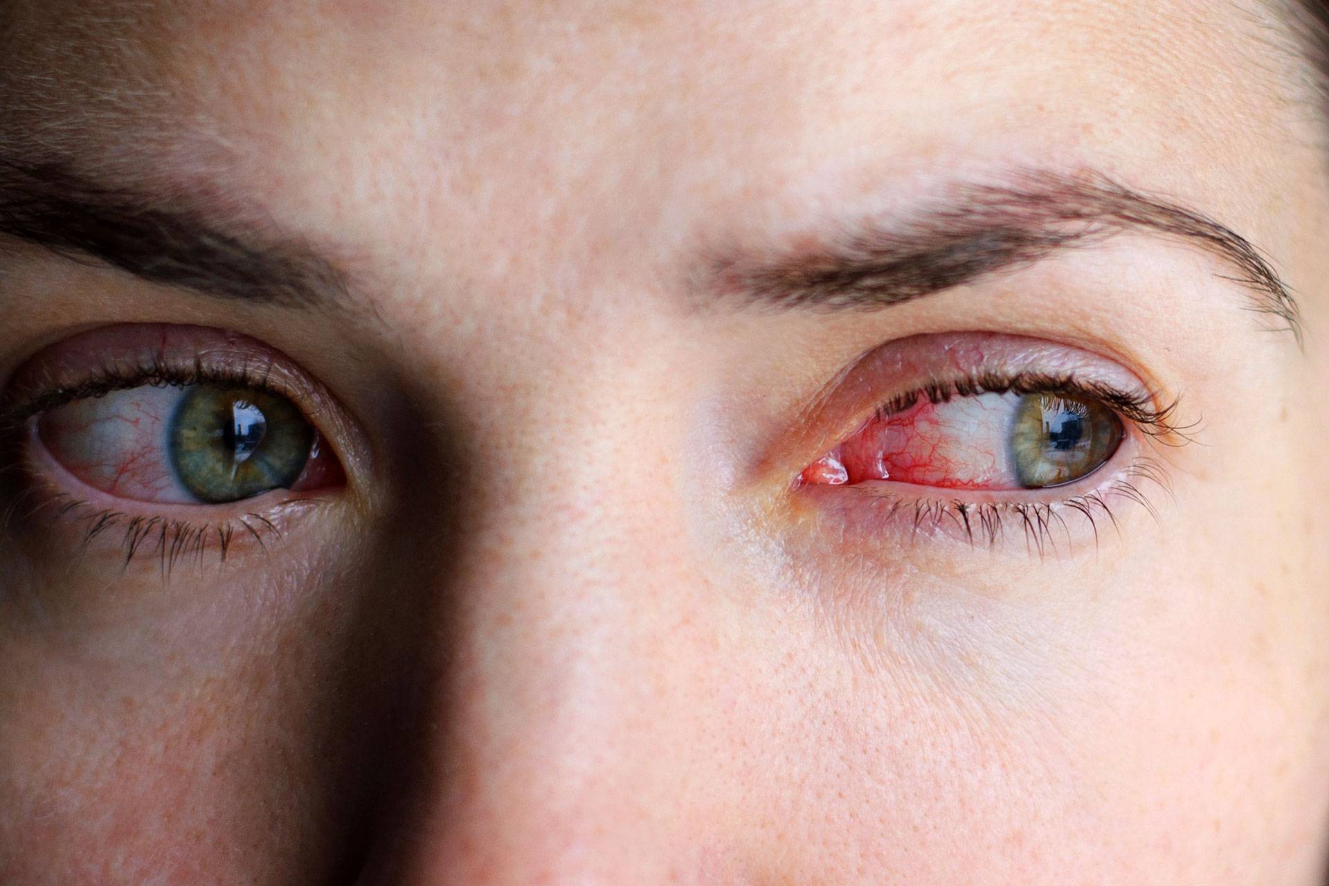 Зуд в глазах: причины и лечение, как снять покраснение, жжение и сухость