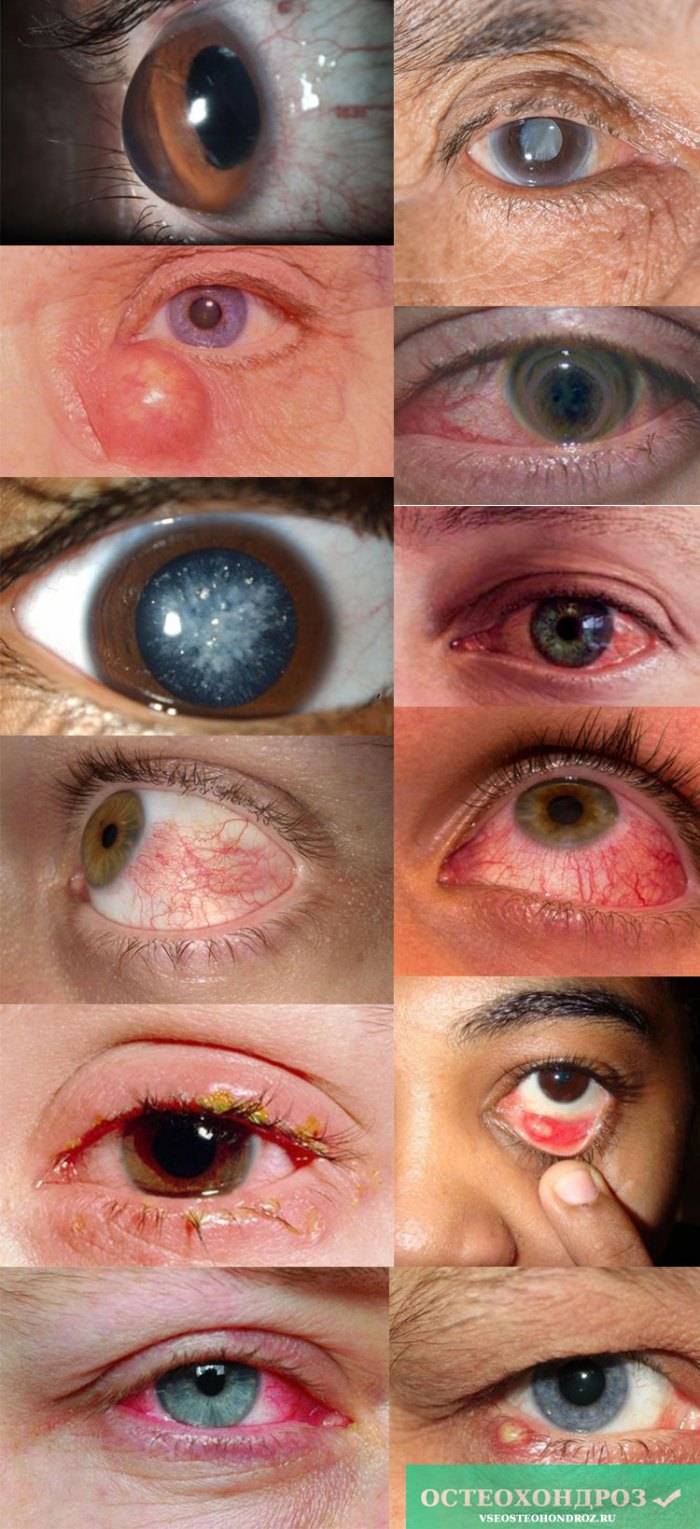 10 необычных болезней глаз, которые могли случиться с каждым