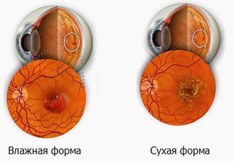 Дистрофия сетчатки глаза: причины, симптомы и лечение