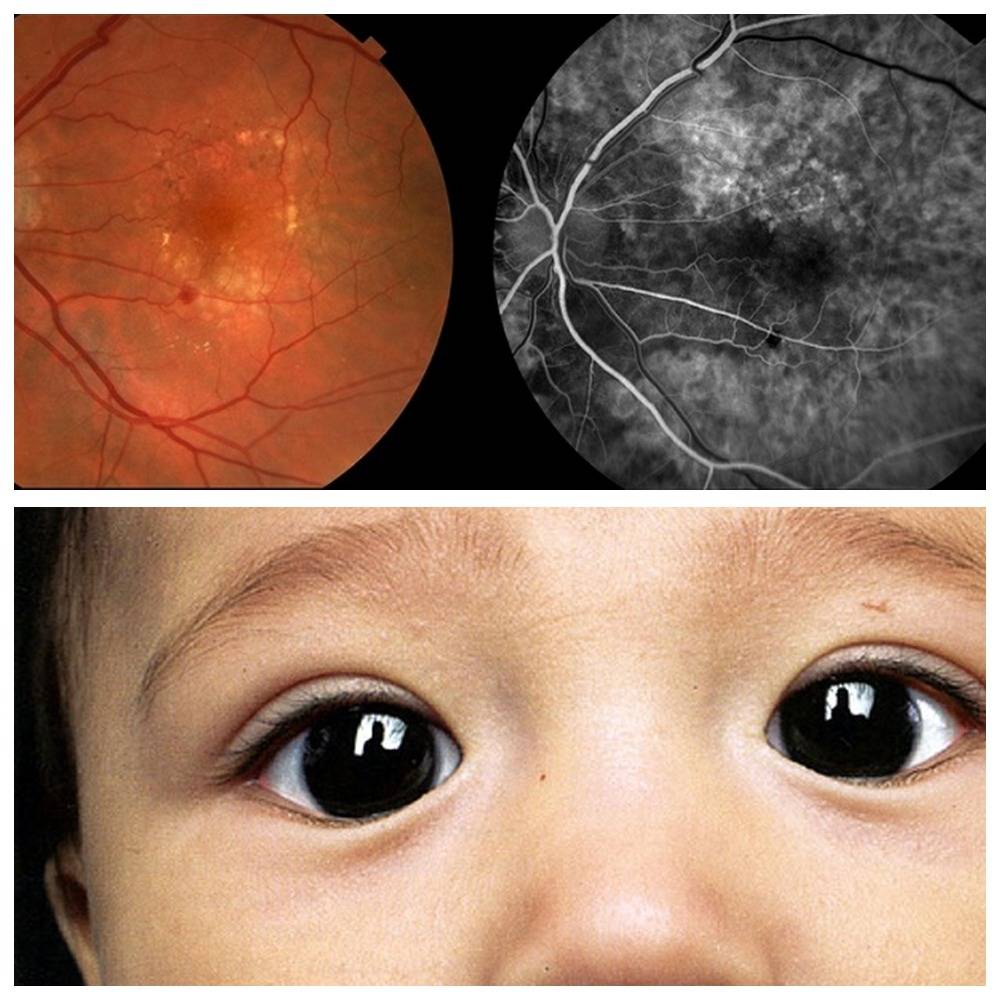Ангиопатия сетчатки глаза у ребенка: что это такое, болезнь сосудов сетчатки обоих глаз у новорожденных и грудничков