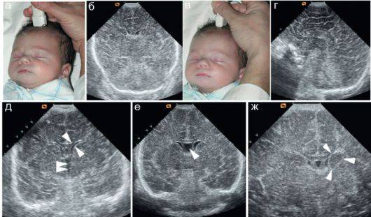 Ангиопатия сетчатки у ребёнка: основные виды и симптомы | компетентно о здоровье на ilive
