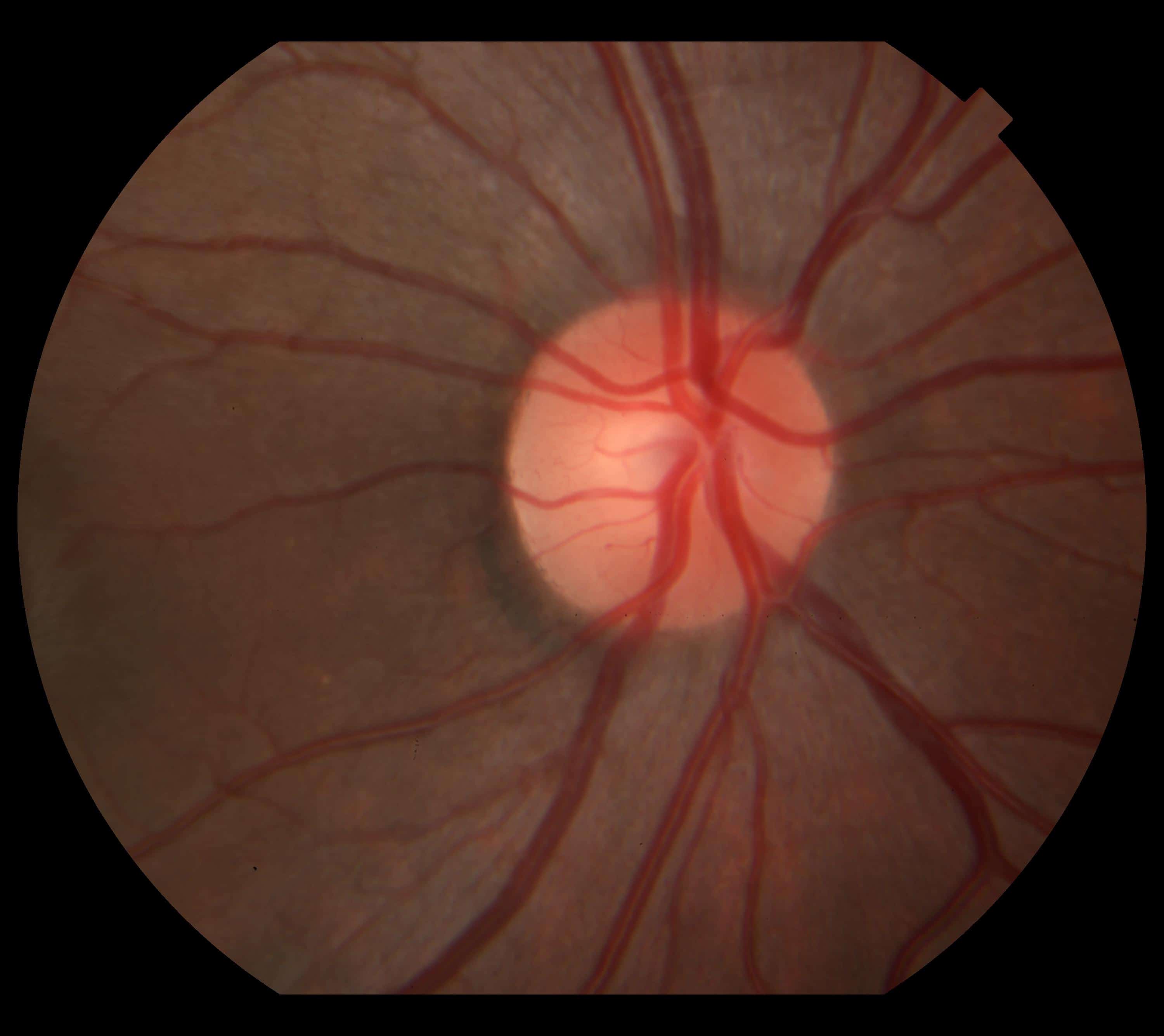 Неврит зрительного (глазного) нерва: симптомы и лечение воспаления