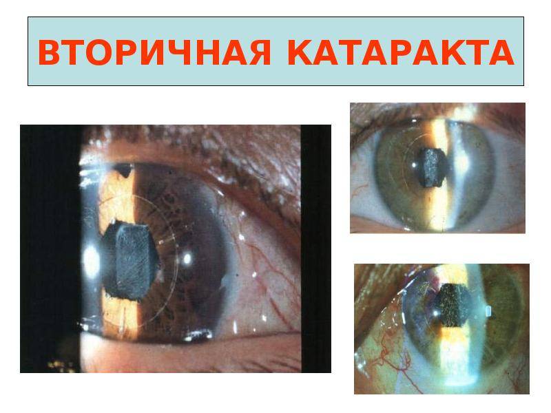 Операция по удалению катаракты: как проводится, показания и реабилитация