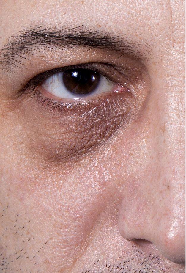 Белые пятна вокруг глаз на веках: что это такое, причины, лечение пятнышек и кругов на коже, удаление, фото, профилактика