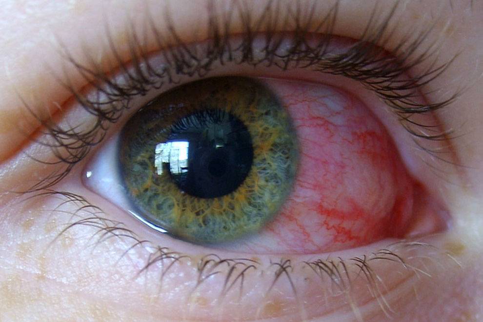 Гиперемия конъюнктивы, причины конъюнктивальной патологии глаз