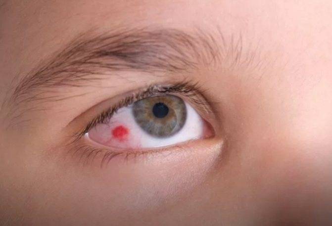 Красные круги под глазами у ребенка, грудничка. причины красноты и припухлости, фото, что это значит. комаровский