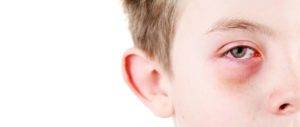 Что делать, если у ребенка покраснел глаз: причины симптома, как лечить, чем можно закапать?