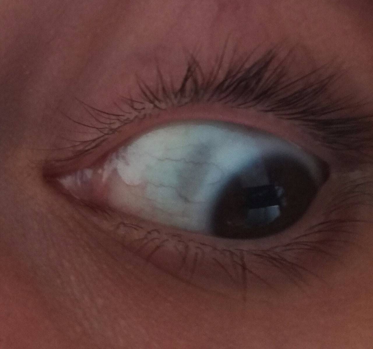 Пятно на белке глаза: причины, лечение, профилактика - "здоровое око"