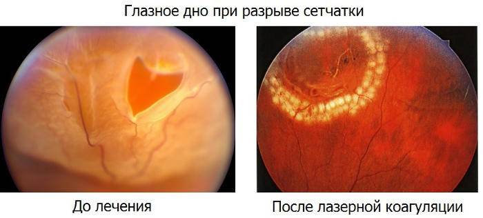 Операция при отслоении сетчатки глаза