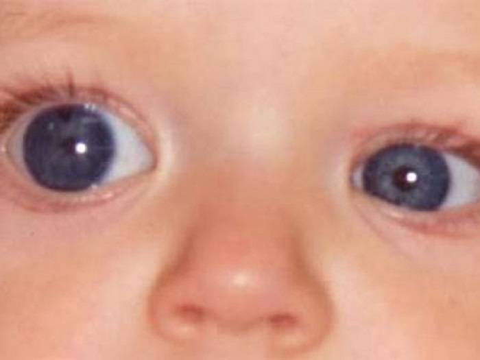 Глаукома у детей - симптомы болезни, профилактика и лечение глаукомы у детей, причины заболевания и его диагностика на eurolab
