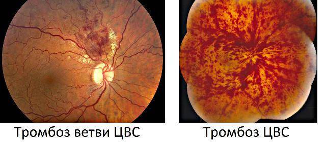Тромбоз глаза (цвс) - лечение, симптомы, причины