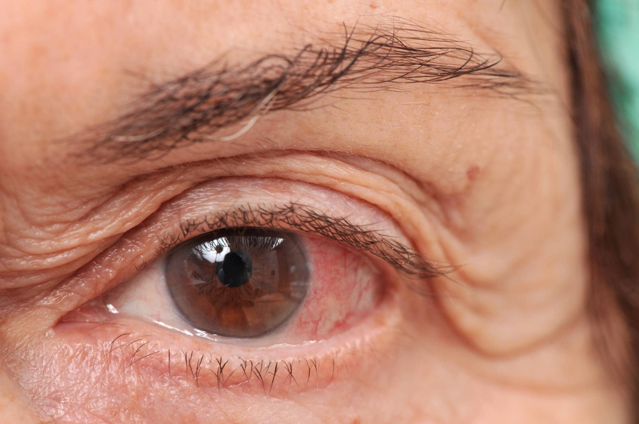 Частое моргание глазами у взрослых возможные причины, способы лечения