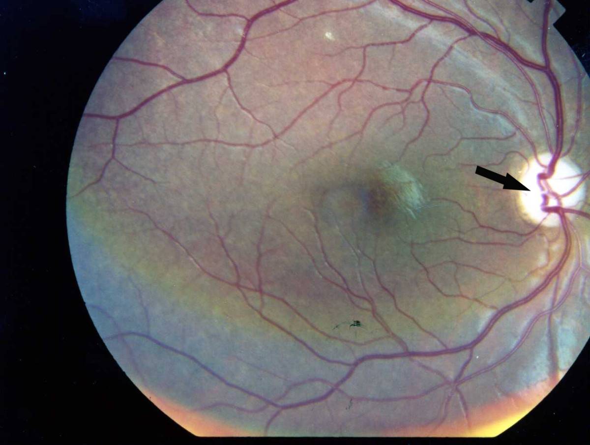 Особенности фоновой ретинопатии и ретинальных сосудистых изменений: симптомы и лечение
