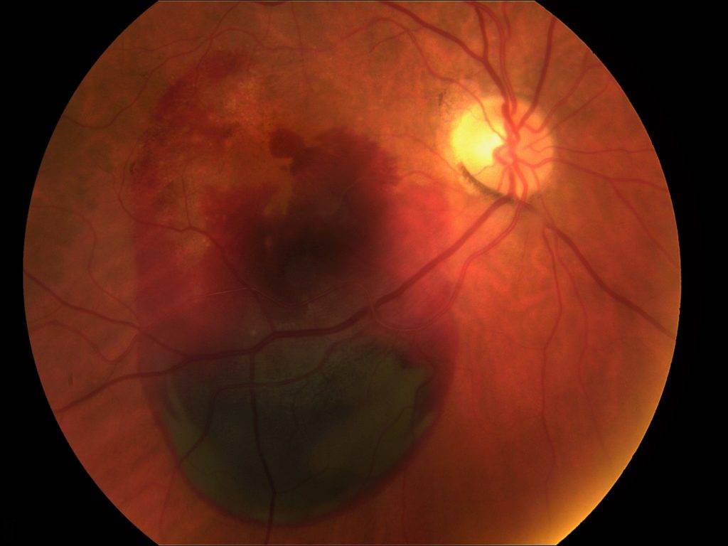 Дистрофия сетчатки глаза - симптомы, лечение, причины
