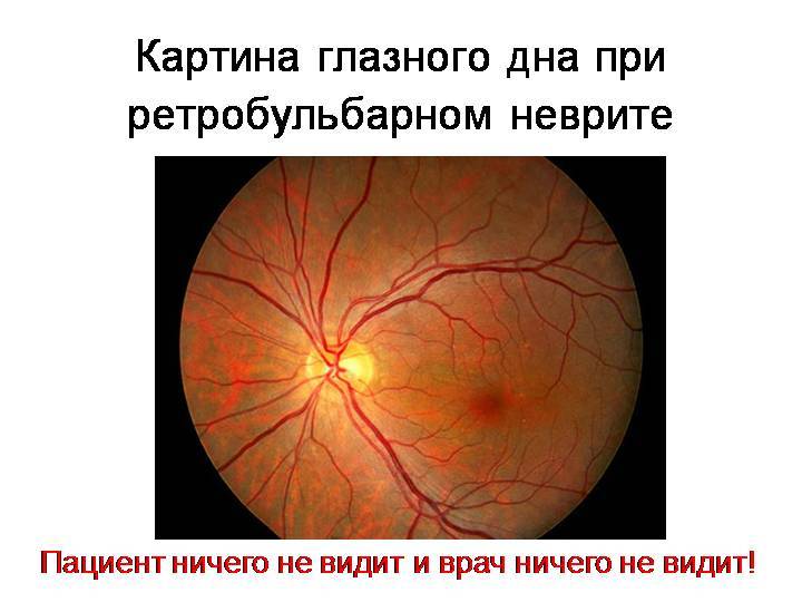 Неврит глазного нерва:  причины, симптомы, лечение и прогноз