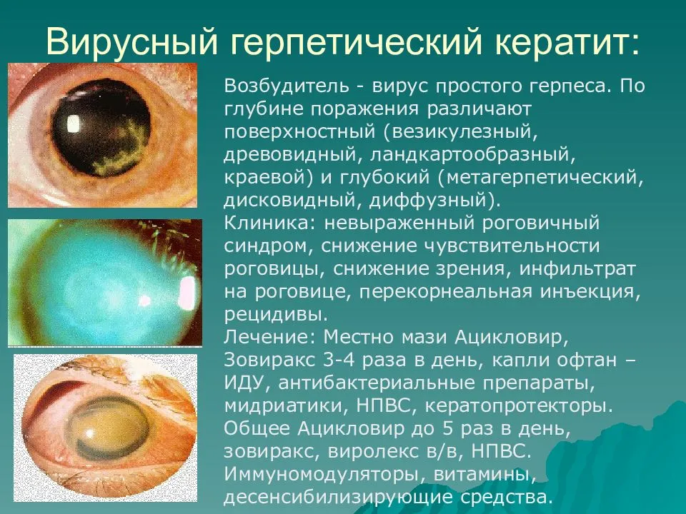 Как проявляется вирусный кератит глаза