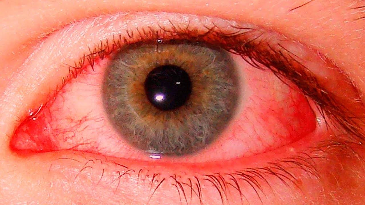Как снять воспаление глаз в домашних условиях - народные средства