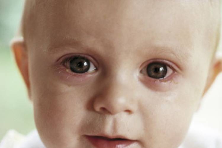 Крайне неприятное заболевание глаз — аллергический конъюнктивит у детей