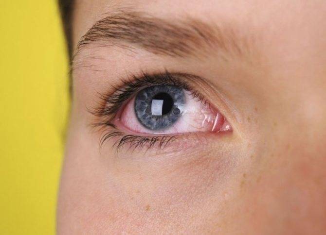Причины возникновения и методы лечения аллергии под глазами
