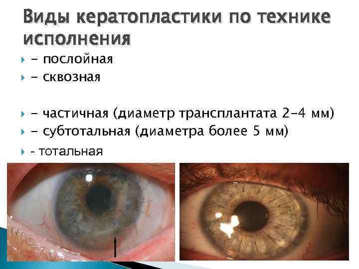 Пересадка роговицы глаза - особенности проведения кератопластики