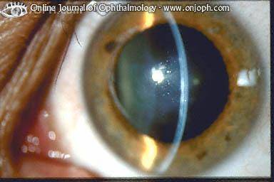 Как остановить болезнь, угрожающую потерей зрения? дистрофия роговицы глаза: лечение