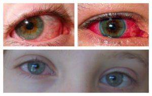 Увеит глаза: симптомы, лечение, причины и последствия