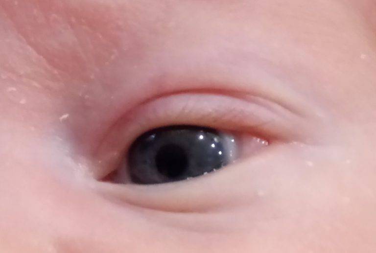 Выделения из глаз у новорожденного (желтые, гнойные) - причины, лечение и профилактика