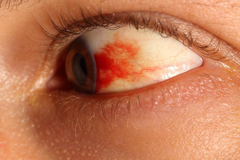 Что делать, если сосуд лопнул в глазу: виды кровоизлияний и лечение