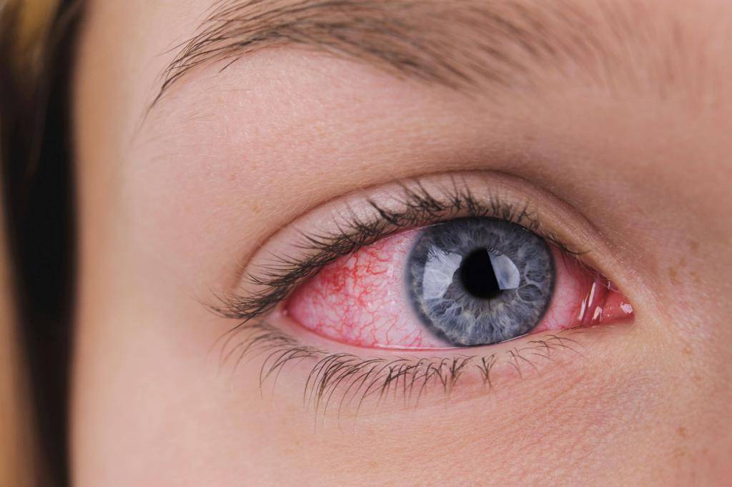 Как убрать покраснение глаз в домашних условиях