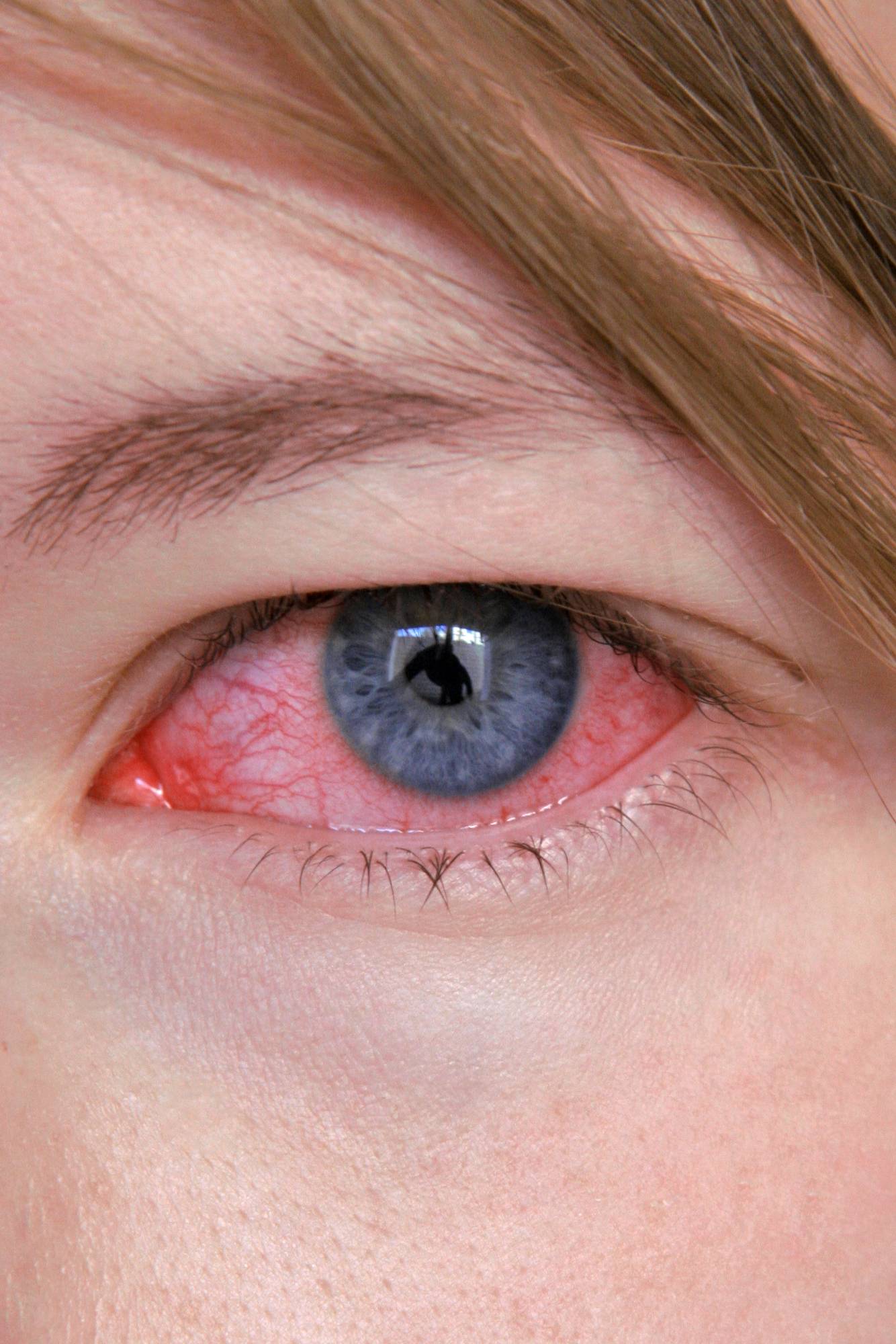 4 вида офтальмии которые могут оставить вас без зрения