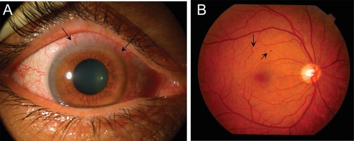 Что такое эпиретинальный фиброз глаз. народные рецепты для лечение фиброза сетчатки глаза - новая медицина