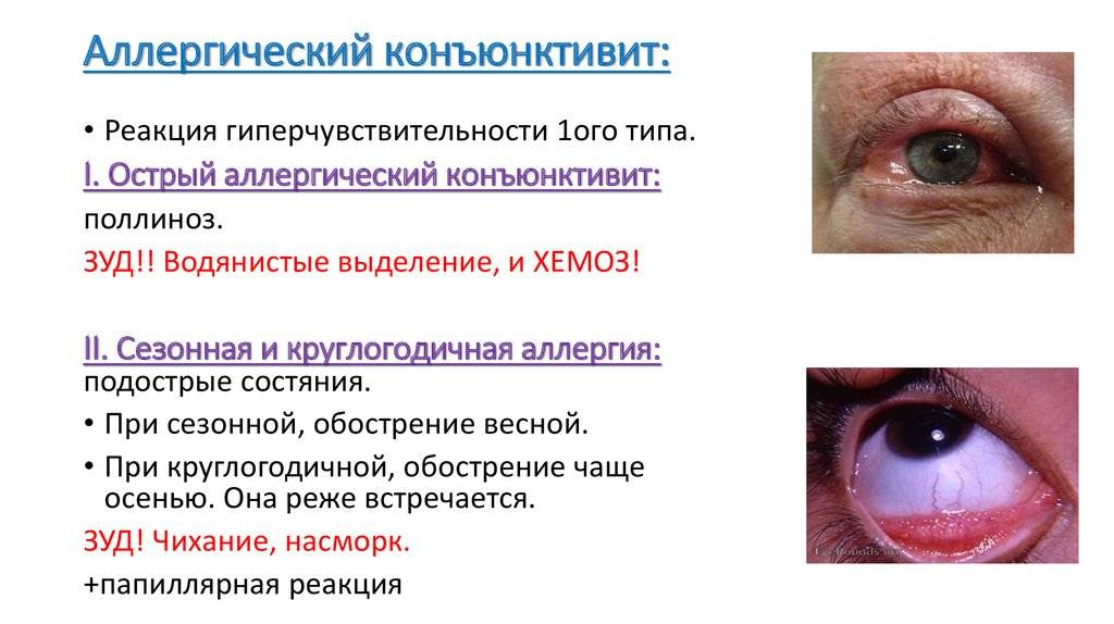 Хемоз конъюнктивы: симптомы и способы лечения - здоровое око | za-rozhdenie.ru