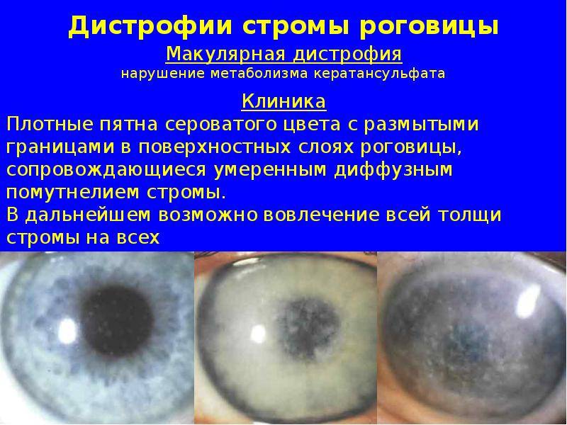 Дистрофия роговицы глаза - что это такое, профилактика и лечение, признаки дистрофии роговицы глаза | медицинский портал spacehealth