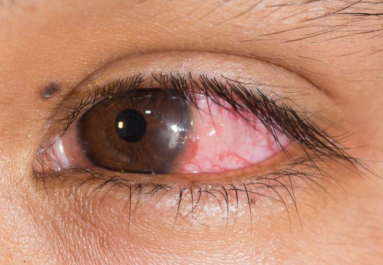 Грибковые заболевания глаз - фото, лечение, симптомы, причины