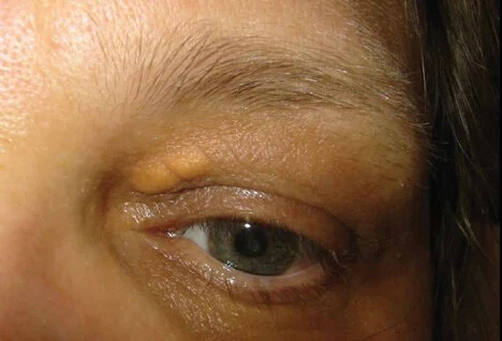 Под глазами желтые пятна, круги: причины появления (на веках, вокруг глаз), симптомы, лечение, препараты, фото