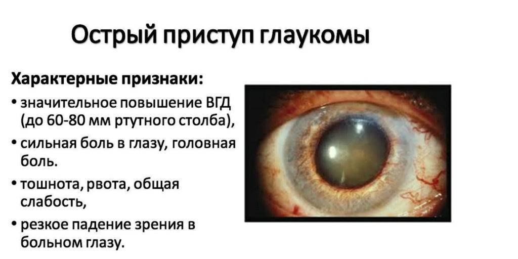 Чем опасен острый приступ глаукомы?